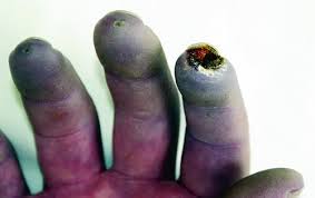 Raynaud Syndrome - Cardiovascular Disorders - MSD Manual ...
